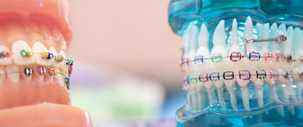 A pair of fake chompers you'd find in an orthodontist's office, both sporting braces bound with colorful rubber bands.